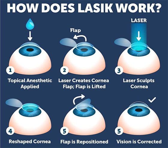 LASIK-Diagram.jpg